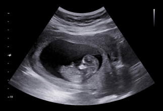 Ultrasound image of tiny baby in the womb