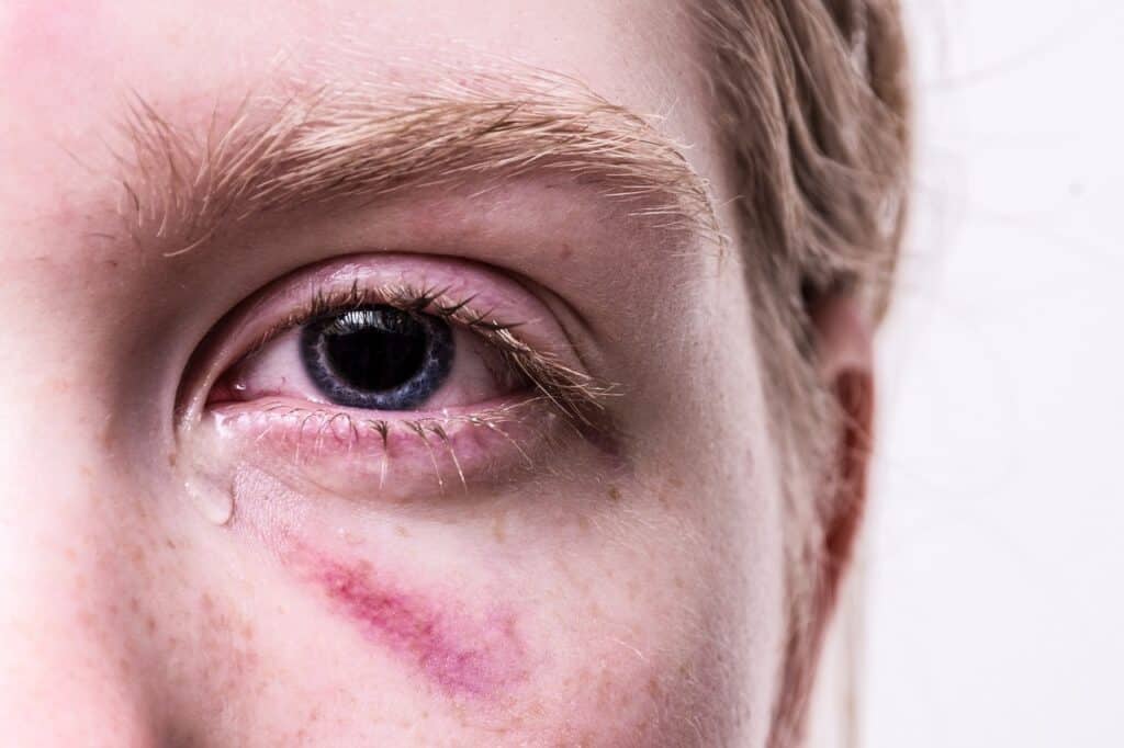 face with black eye