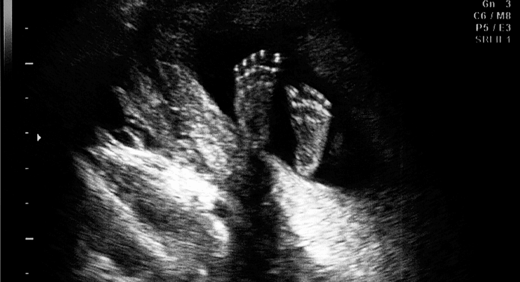 an ultrasound shows a baby's feet