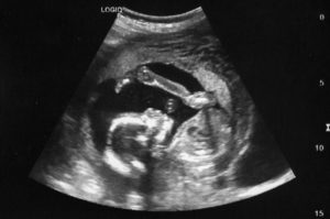 An abortion image of a child further along in pregnancy. Example of a real live abortion procedure video.