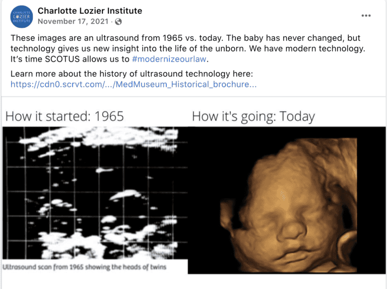 Overturning Roe v. Wade photo from Lozier Institute picturing an ultrasound from the 1960s and one from modern day/