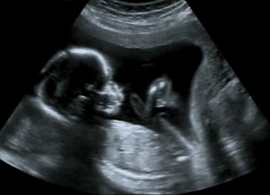 Ultrasound photo of baby